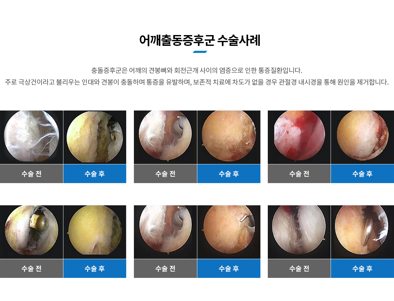 어깨충돌증후군 수술사례